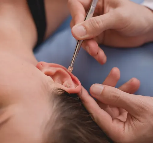 Auriculoterapia